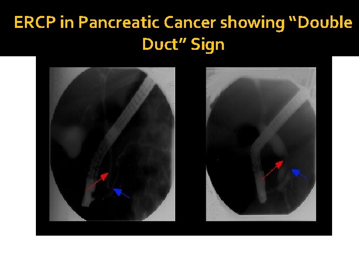 ERCP in Pancreatic Cancer showing “Double Duct” Sign 