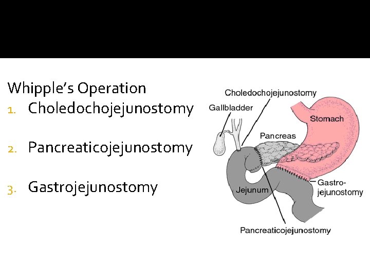 Whipple’s Operation 1. Choledochojejunostomy 2. Pancreaticojejunostomy 3. Gastrojejunostomy 