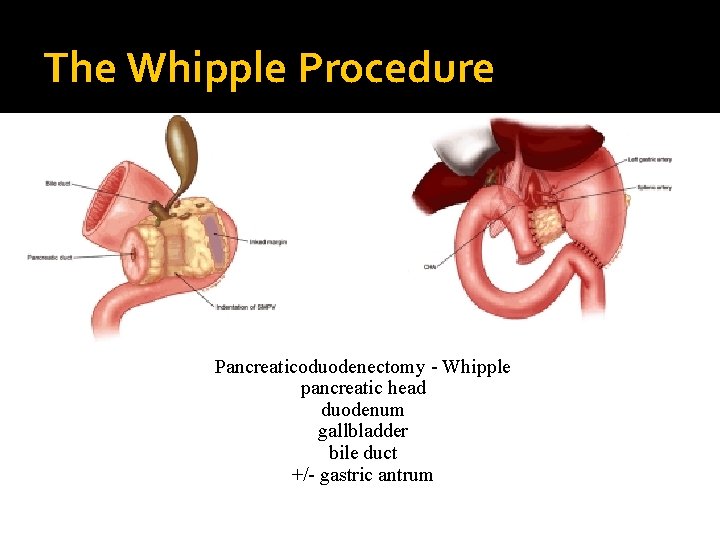 The Whipple Procedure Pancreaticoduodenectomy - Whipple pancreatic head duodenum gallbladder bile duct +/- gastric