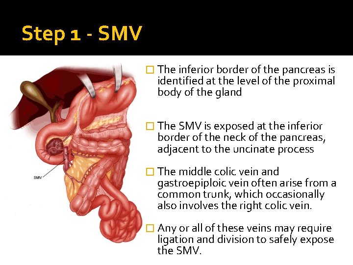 Step 1 - SMV � The inferior border of the pancreas is identified at