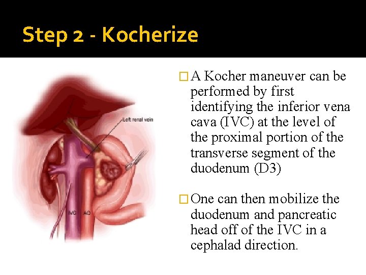 Step 2 - Kocherize �A Kocher maneuver can be performed by first identifying the