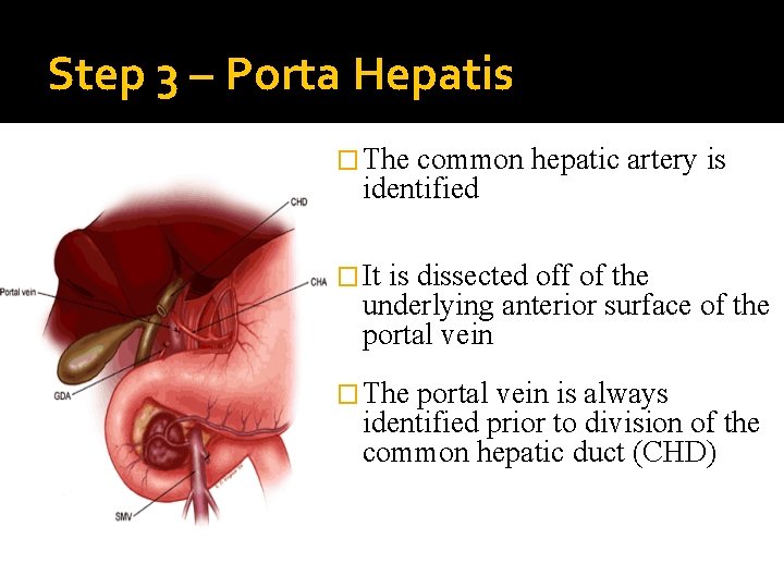 Step 3 – Porta Hepatis � The common hepatic artery is identified � It