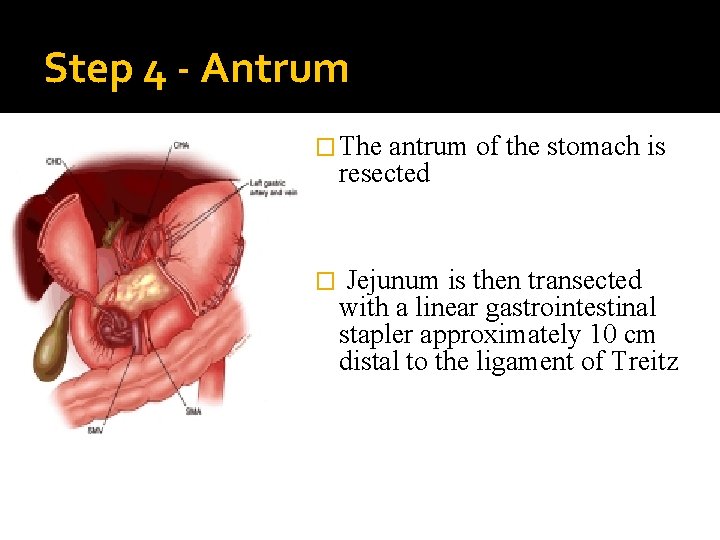 Step 4 - Antrum � The antrum of the stomach is resected � Jejunum