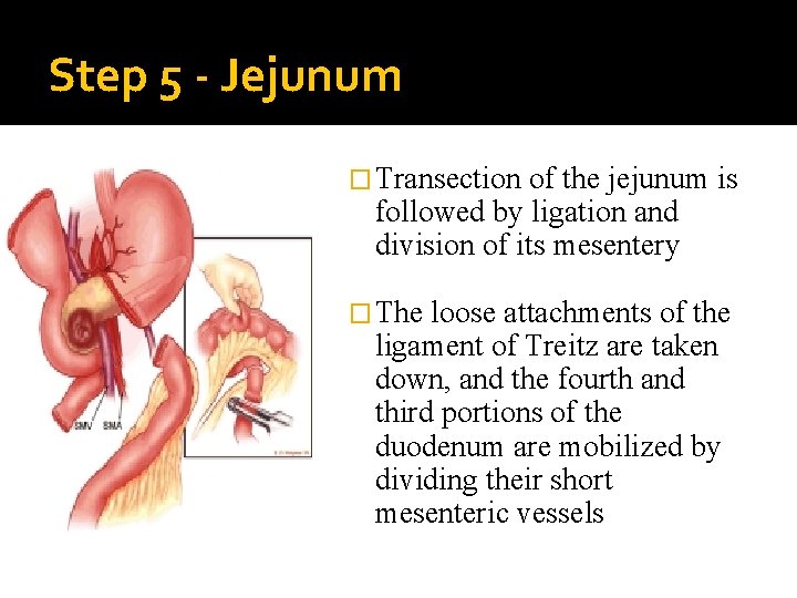 Step 5 - Jejunum � Transection of the jejunum is followed by ligation and