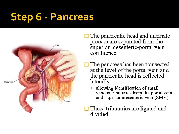 Step 6 - Pancreas � The pancreatic head and uncinate process are separated from