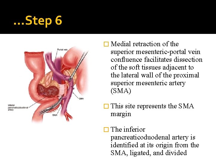 …Step 6 � Medial retraction of the superior mesenteric-portal vein confluence facilitates dissection of