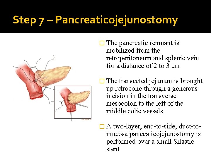 Step 7 – Pancreaticojejunostomy � The pancreatic remnant is mobilized from the retroperitoneum and