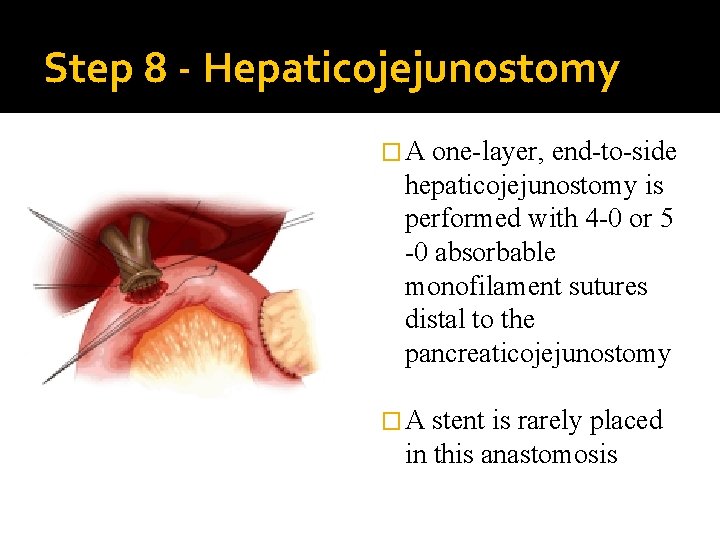 Step 8 - Hepaticojejunostomy �A one-layer, end-to-side hepaticojejunostomy is performed with 4 -0 or
