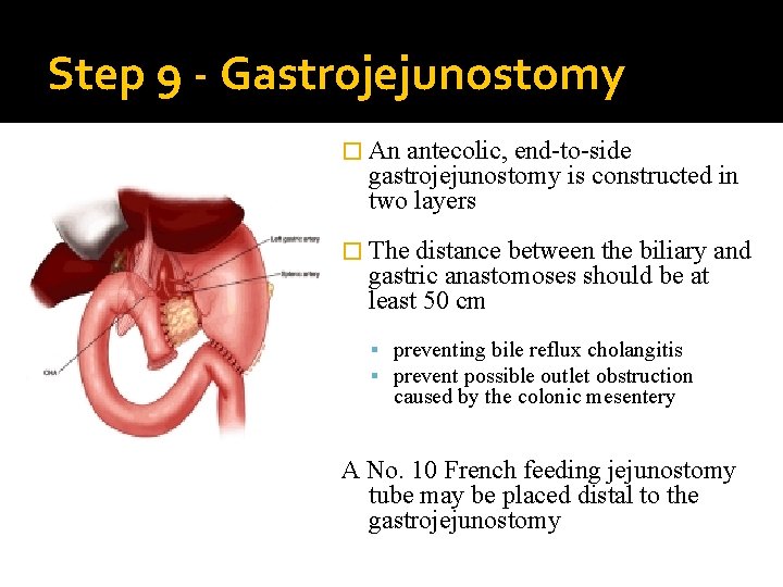 Step 9 - Gastrojejunostomy � An antecolic, end-to-side gastrojejunostomy is constructed in two layers