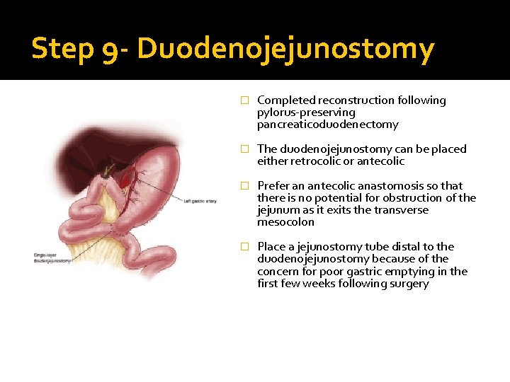 Step 9 - Duodenojejunostomy � Completed reconstruction following pylorus-preserving pancreaticoduodenectomy � The duodenojejunostomy can