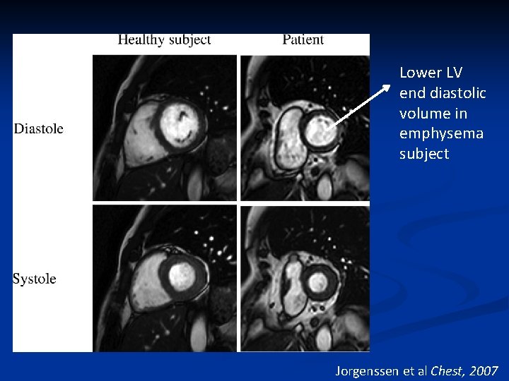 Lower LV end diastolic volume in emphysema subject Jorgenssen et al Chest, 2007 Lower LV end diastolic volume in emphysema subject Jorgenssen et al Chest, 2007