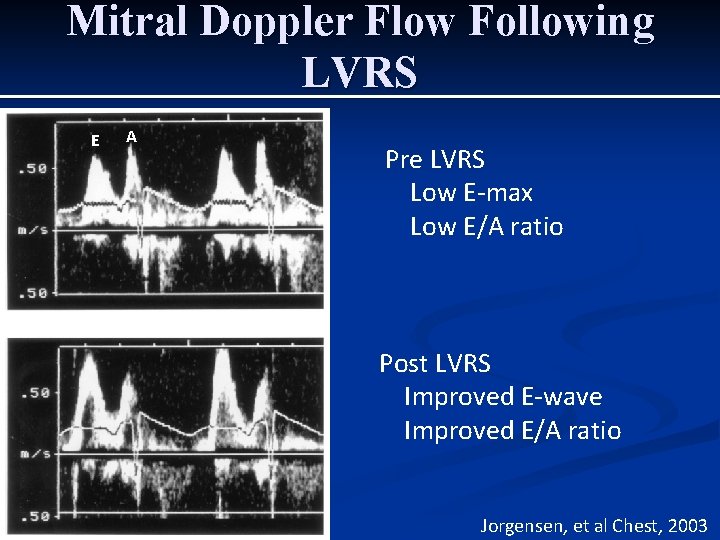 Mitral Doppler Flow Following LVRS E A Pre LVRS Low E-max Low E/A ratio Mitral Doppler Flow Following LVRS E A Pre LVRS Low E-max Low E/A ratio