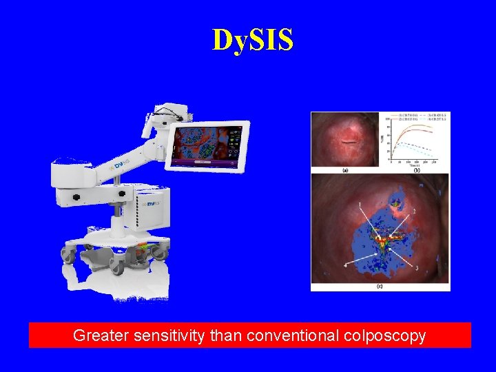 Dy. SIS Greater sensitivity than conventional colposcopy 