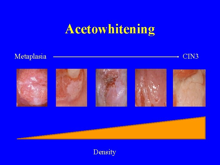 Acetowhitening Metaplasia CIN 3 Density 