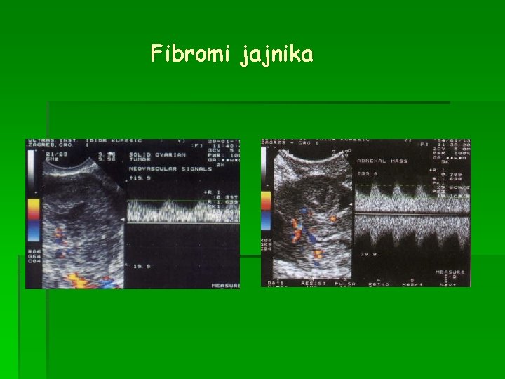 Fibromi jajnika 