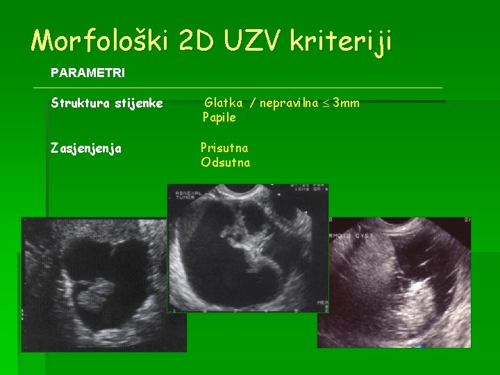 Morfološki 2 D UZV kriteriji PARAMETRI Struktura stijenke Glatka / nepravilna 3 mm Papile