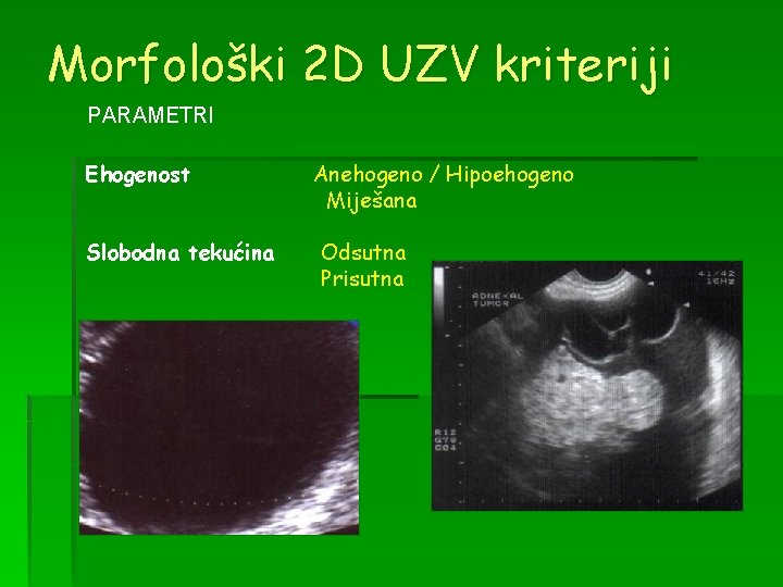 Morfološki 2 D UZV kriteriji PARAMETRI Ehogenost Slobodna tekućina Anehogeno / Hipoehogeno Miješana Odsutna