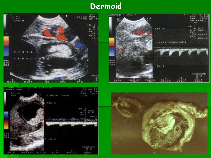 Dermoid 