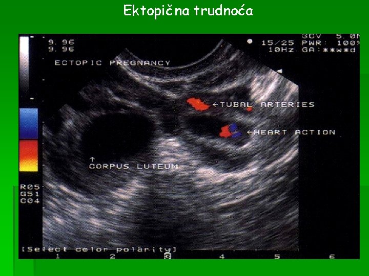 Ektopična trudnoća 