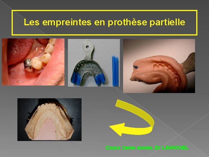 Les empreintes en prothèse partielle Cours 2 eme année, Dr LAHIOUEL 