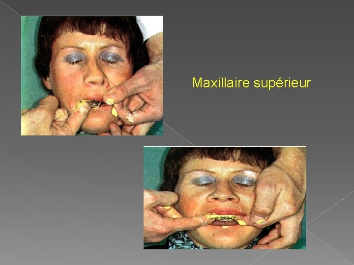 Maxillaire supérieur 