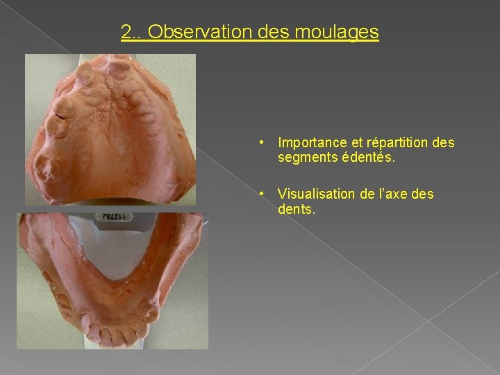 2. . Observation des moulages • Importance et répartition des segments édentés. • Visualisation