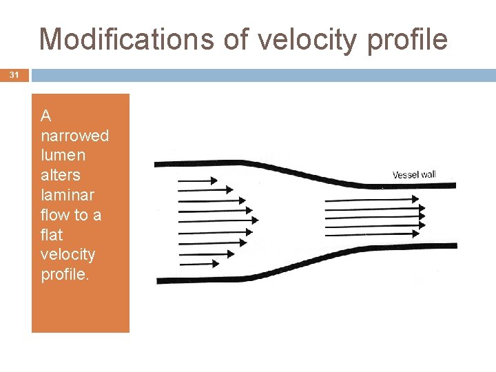 Modifications of velocity profile 31 A narrowed lumen alters laminar flow to a flat