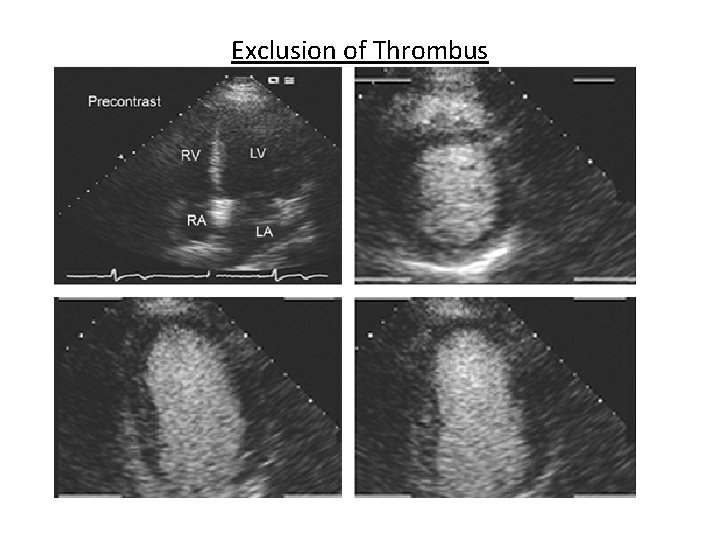 Exclusion of Thrombus 