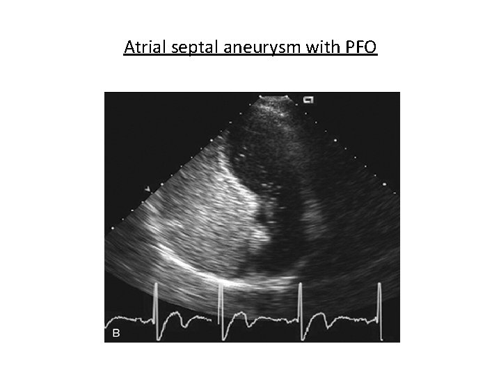 Atrial septal aneurysm with PFO Atrial septal aneurysm with PFO