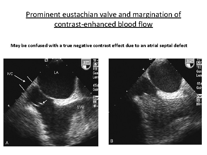 Prominent eustachian valve and margination of contrast-enhanced blood flow May be confused with a