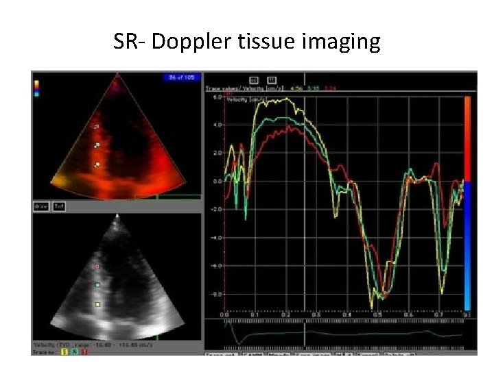 SR- Doppler tissue imaging SR- Doppler tissue imaging
