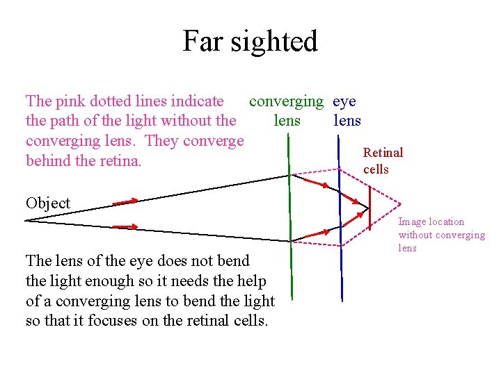 Far sighted The pink dotted lines indicate converging eye the path of the light