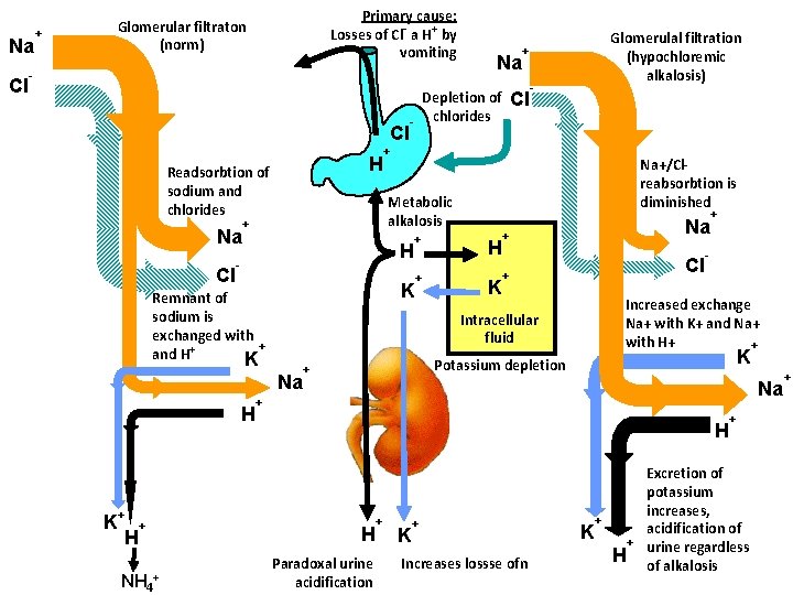 Na Cl + Primary cause: Losses of Cl- a H+ by vomiting Glomerular filtraton