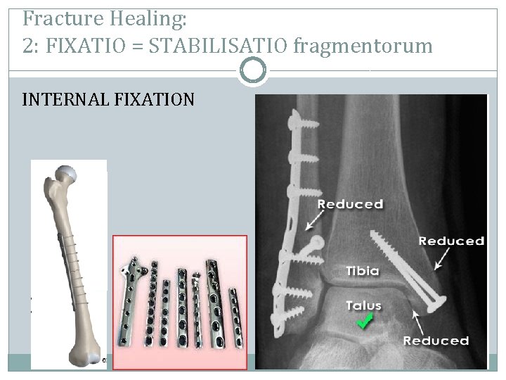 Fracture Healing: 2: FIXATIO = STABILISATIO fragmentorum INTERNAL FIXATION 