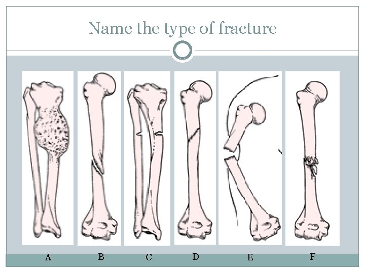 Name the type of fracture A B C D E F 