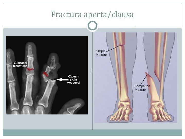 Fractura aperta/clausa 