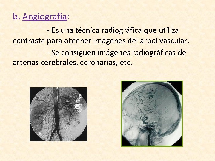 b. Angiografía: - Es una técnica radiográfica que utiliza contraste para obtener imágenes del