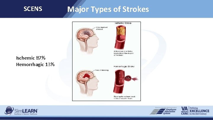 SCENS Ischemic 87% Hemorrhagic 13% Major Types of Strokes 