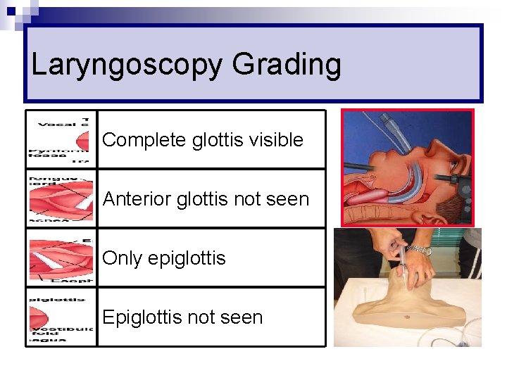 Laryngoscopy Grading Complete glottis visible Anterior glottis not seen Only epiglottis Epiglottis not seen