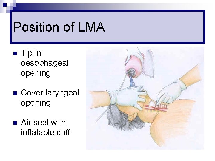 Position of LMA n Tip in oesophageal opening n Cover laryngeal opening n Air