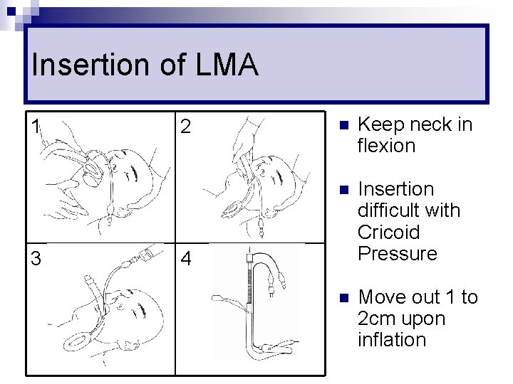 Insertion of LMA 1 3 2 n Keep neck in flexion n Insertion difficult