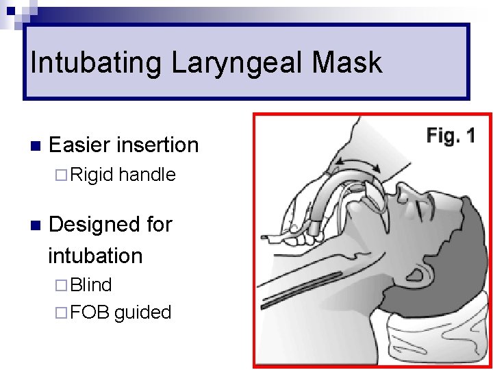 Intubating Laryngeal Mask n Easier insertion ¨ Rigid n handle Designed for intubation ¨