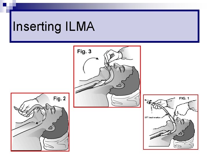 Inserting ILMA 