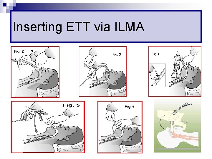 Inserting ETT via ILMA 