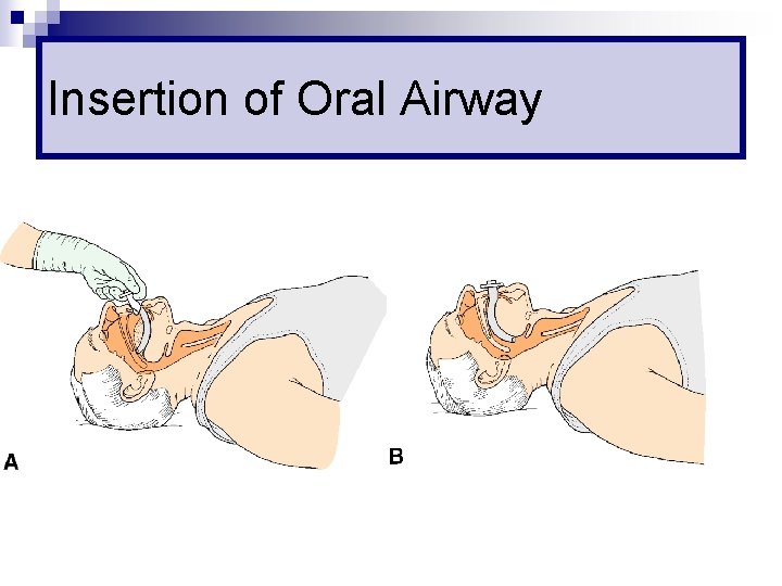 Insertion of Oral Airway 
