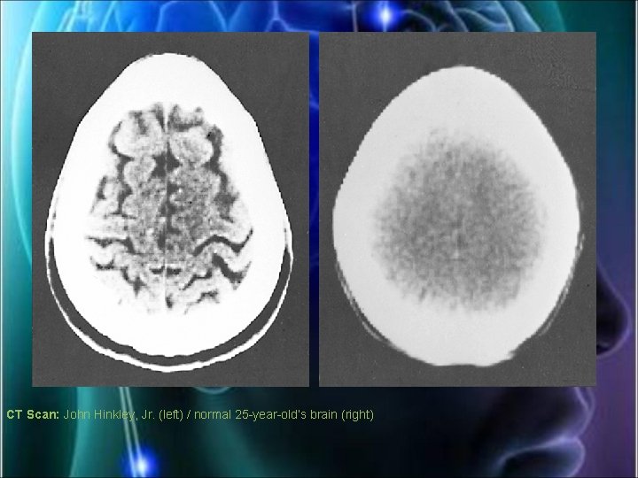 CT Scan: John Hinkley, Jr. (left) / normal 25 -year-old’s brain (right) 