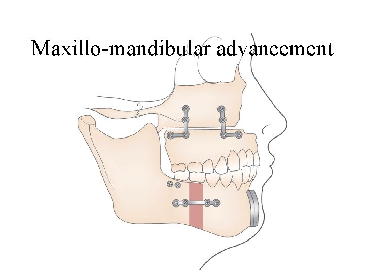 Maxillo-mandibular advancement 