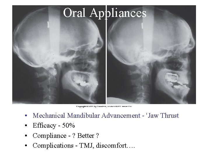 Oral Appliances • • Mechanical Mandibular Advancement - ‘Jaw Thrust Efficacy - 50% Compliance