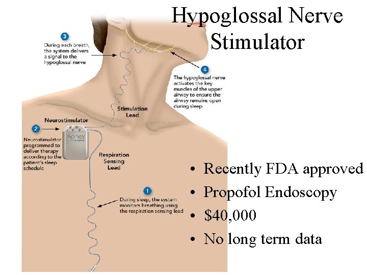 Hypoglossal Nerve Stimulator • • Recently FDA approved Propofol Endoscopy $40, 000 No long
