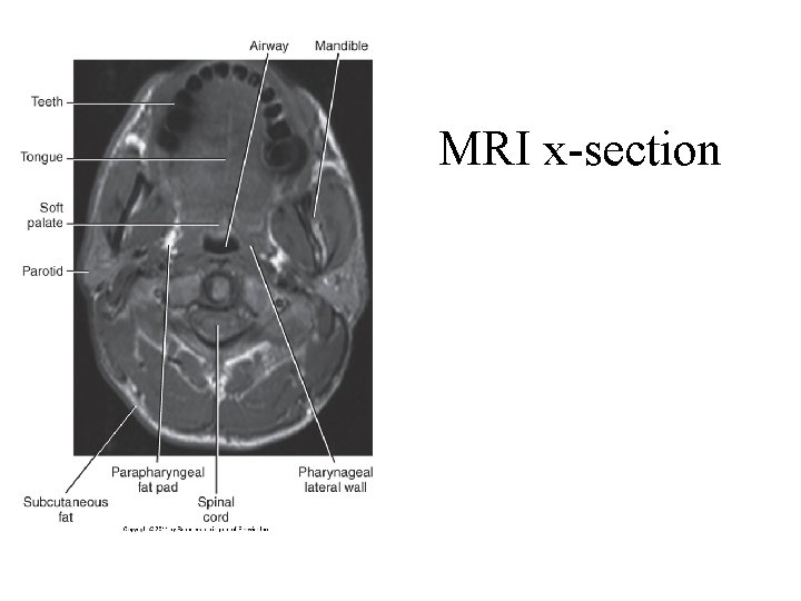 MRI x-section 